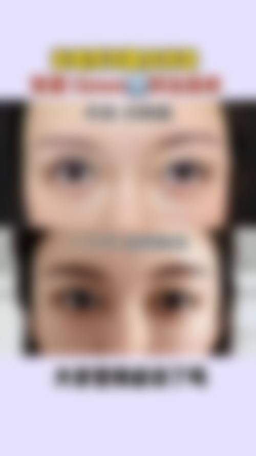 西安艺星宋蔚做双眼皮，医生资质与经验如何？