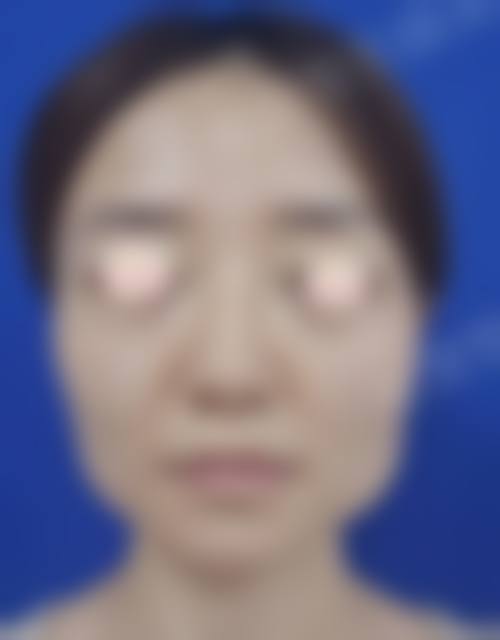 北京圣嘉新医疗美容医院下颌角磨骨技术怎么样？了解磨骨技术