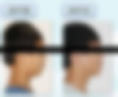 北京圣嘉新医疗美容医院下颌角磨骨要等多久？了解手术排队情况