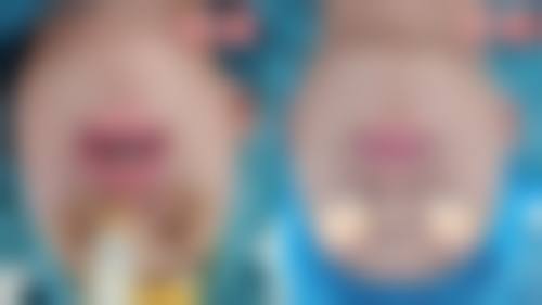 北京圣嘉新医疗美容医院下颌角磨骨成效好吗？亲身经历手术过程