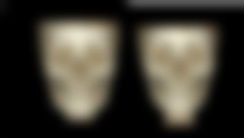 亲测北京圣嘉新医疗美容医院下颌角磨骨！脸型蜕变，术后恢复快效果自然超满意