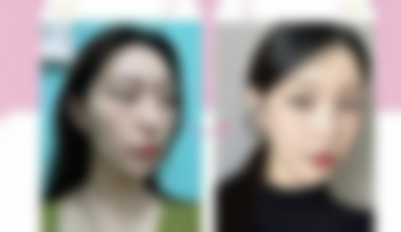 北京圣嘉新医疗美容医院下颌角磨骨值得推荐吗？总结评价