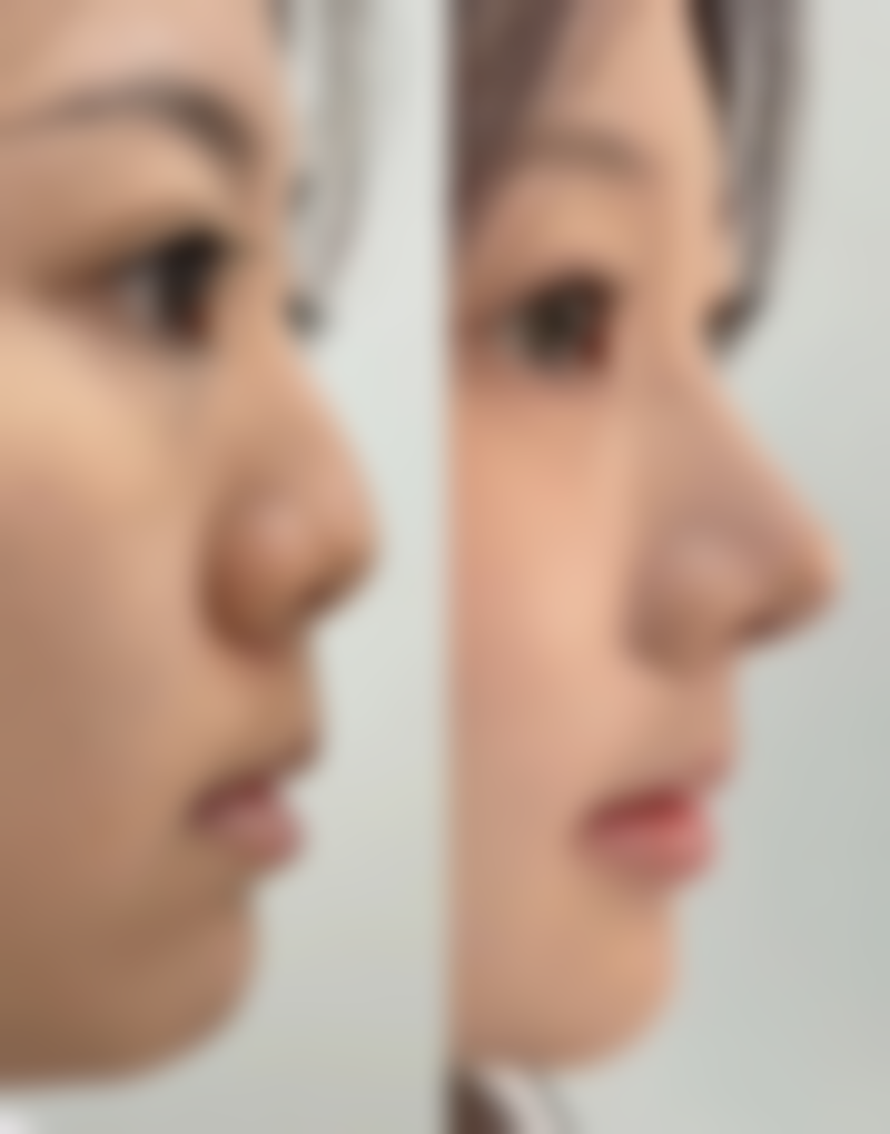 怎样自测法令纹和木偶纹的程度呢？