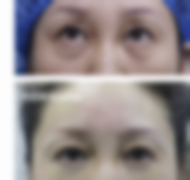 治疗法令纹和木偶纹有哪些注意事项呢？