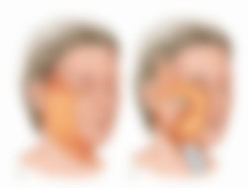 不同类型的凹陷性疤痕（如痘坑、外伤后凹陷）有什么对应方案？