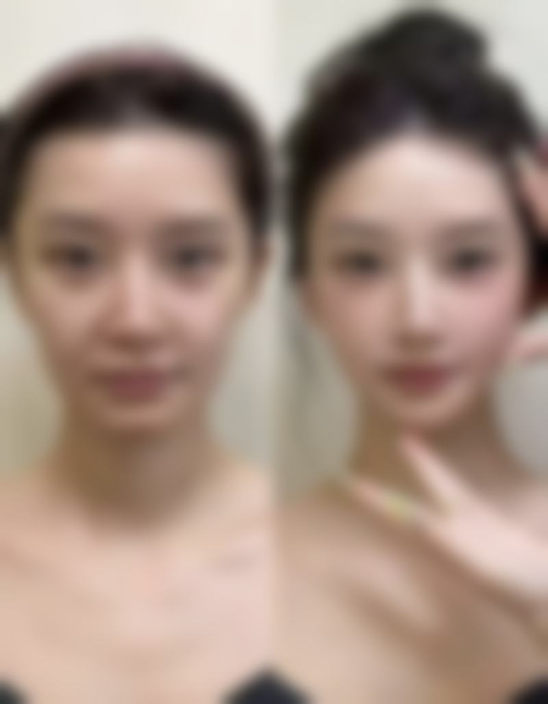 增生性疤痕（凸起、发红）该怎么治疗？