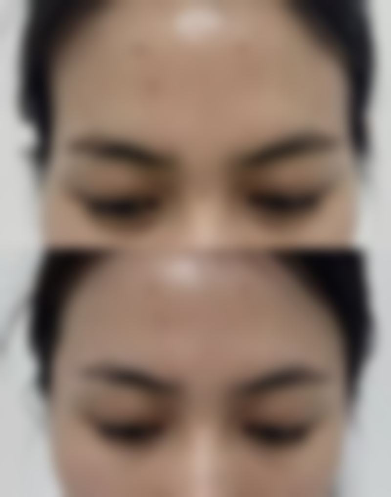 脸部抽脂手术出现的大部分副作用都能修复吗?