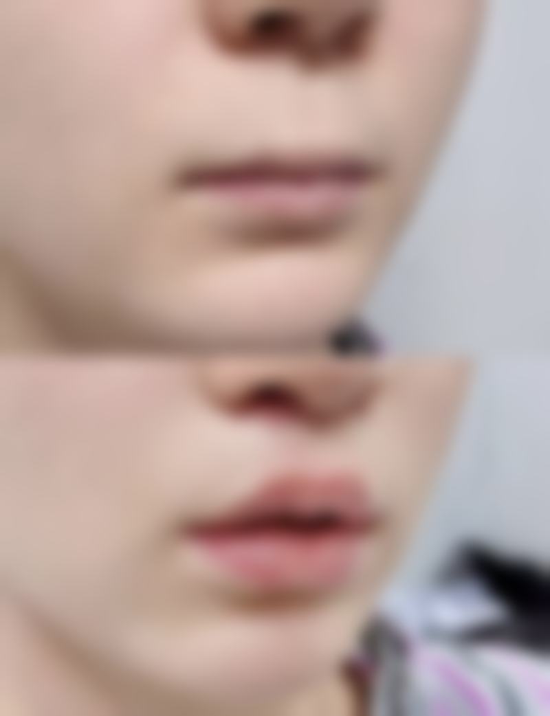 为什么说部分情况眼袋可恒久去除呢？