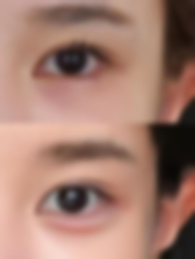 产后什么时候可以考虑割双眼皮呢？