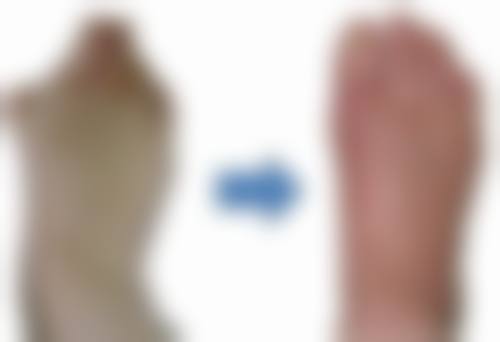 激光治疗脸部疤痕疙瘩成效如何？