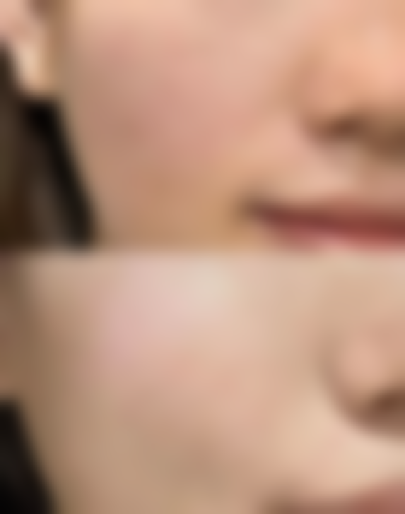 yestar艺星埋线双眼皮医院适合60岁人群吗？