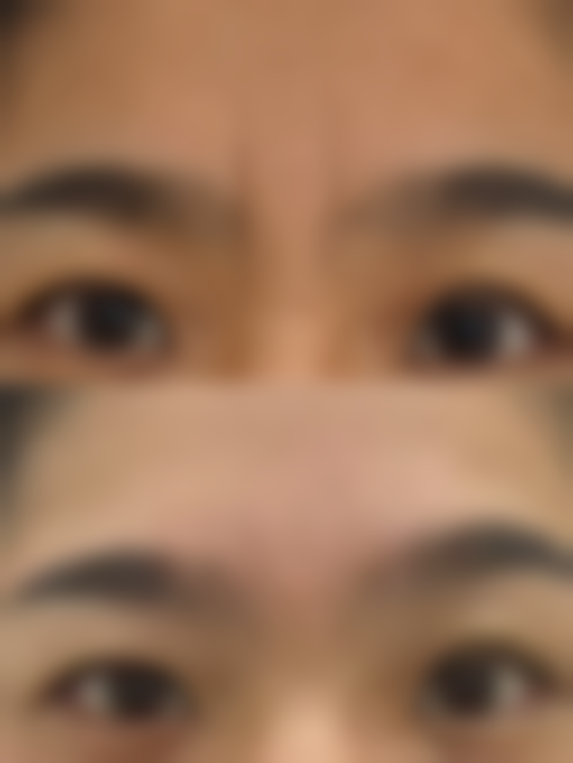 如何减少疤痕增生之其他方法