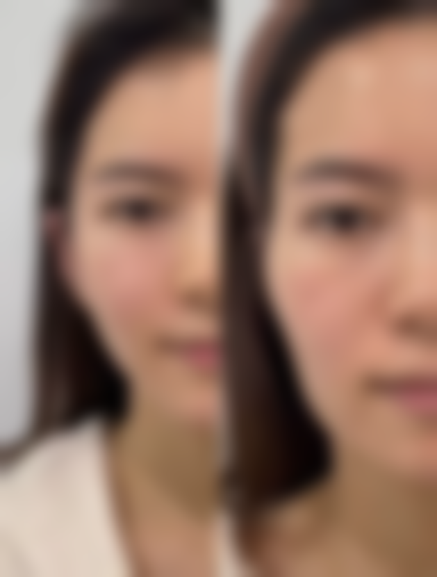 手术相关因素导致双眼皮眼角发白的正常现象有哪些？