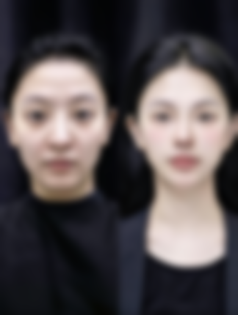 35岁女人做完双眼皮手术后修复会特别慢吗？