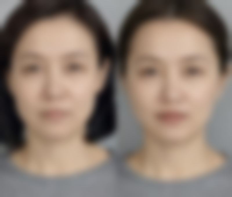 60岁割双眼皮能达到理想成效吗？