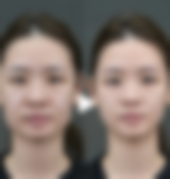 治疗增生的疤痕疙瘩后，有哪些美学管理建议？