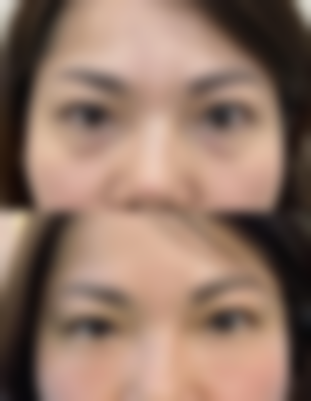 治疗增生的疤痕疙瘩需要注意些什么？