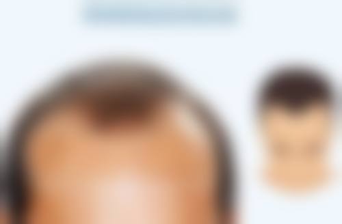 种植头发后会出现哪些术后不适呢？