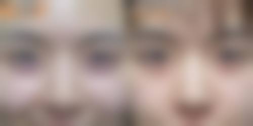 术后护理对六点定位双眼皮维持时间重要吗？