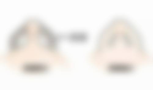 年龄对六点定位双眼皮维持时间有什么影响？