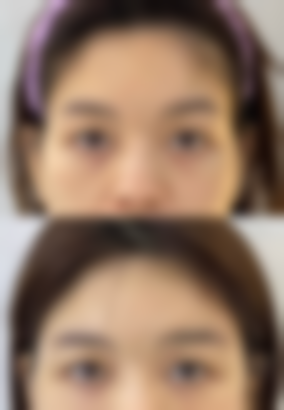 假体隆胸后有什么维护建议吗？