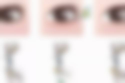 那对于35岁双眼皮上眼皮松弛，应该怎么选择改善方案呢？