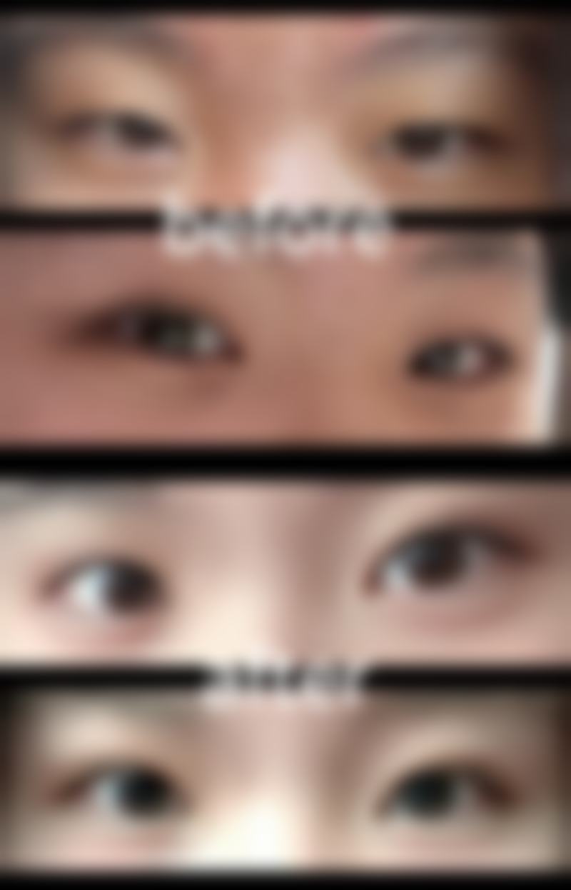 双眼皮宽改窄有哪些方法呢？