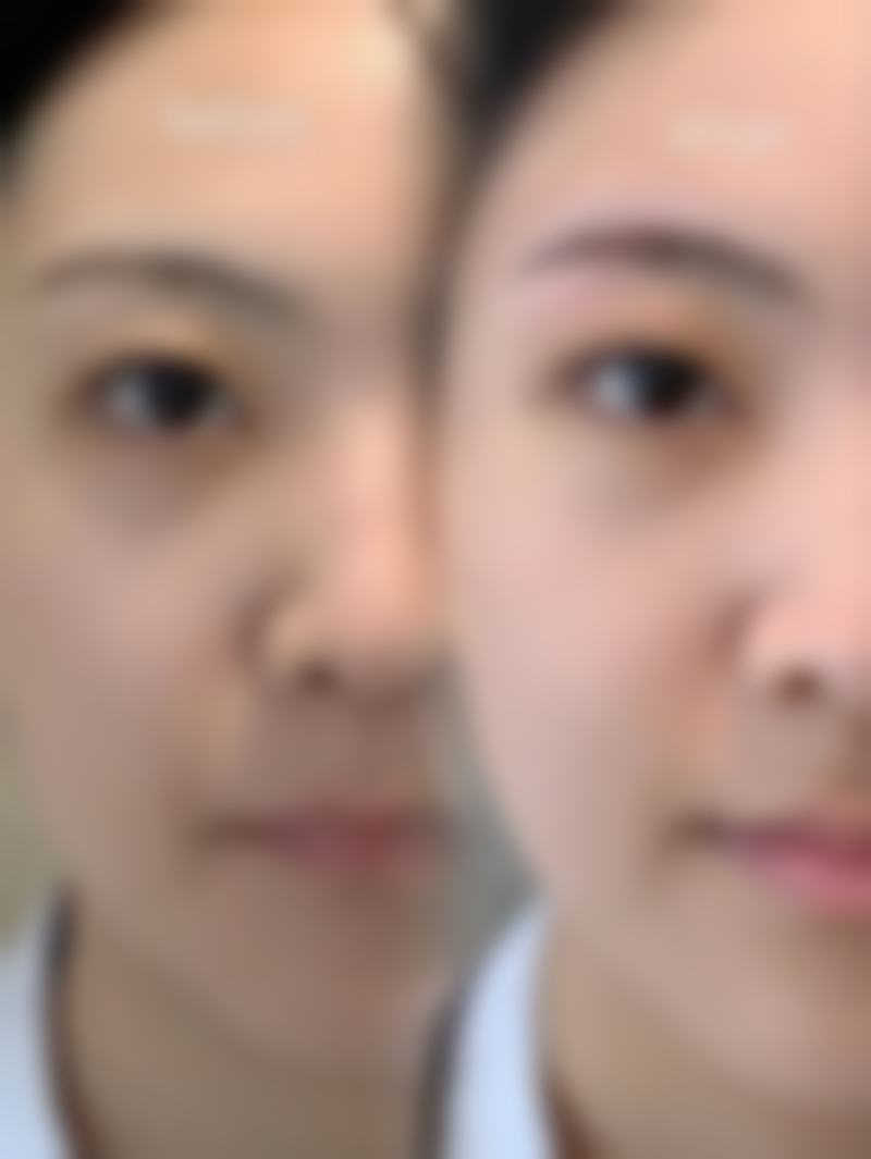 增生性热油疤痕有什么修复建议？