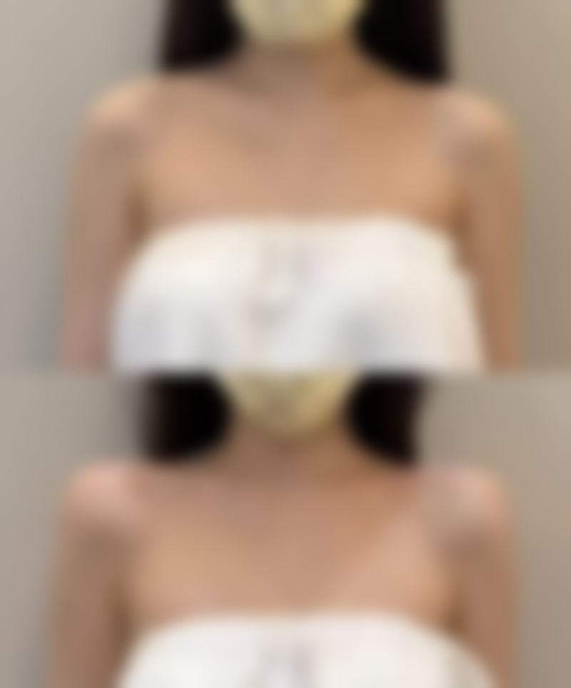 全切双眼皮术后五个月眼皮仍发红，这又该如何处理呢？