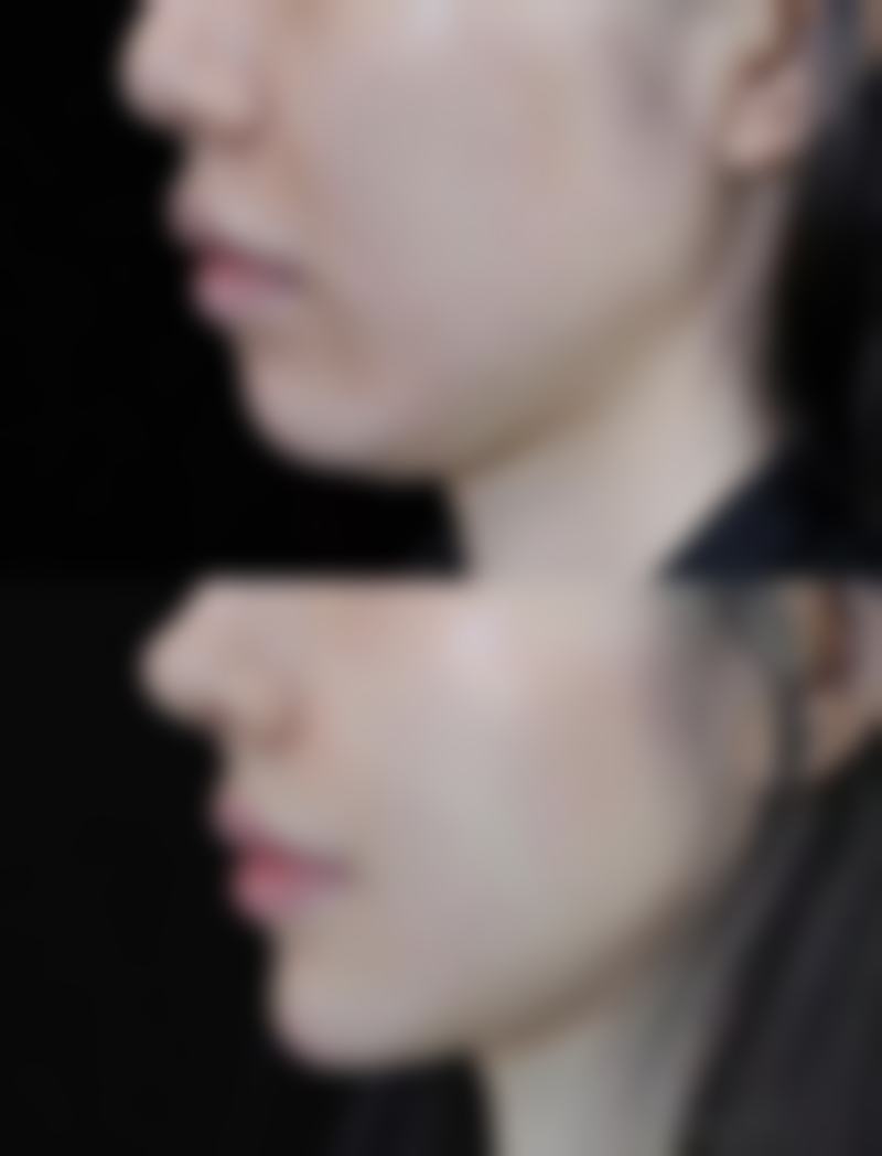 眼睛小的人想做双眼皮手术，选择医院和医生重要吗？