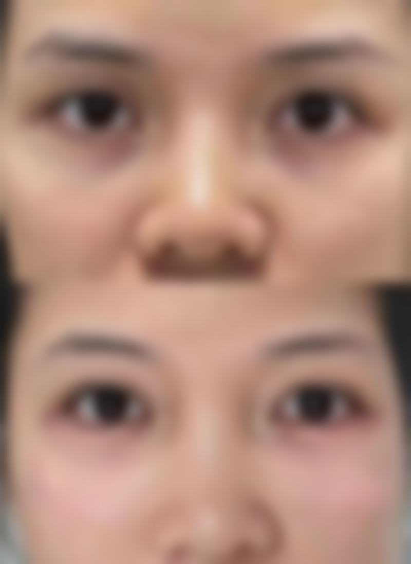 天生肿眼泡做双眼皮适合哪种手术？全切双眼皮与埋线双眼皮哪个更适合你？ 