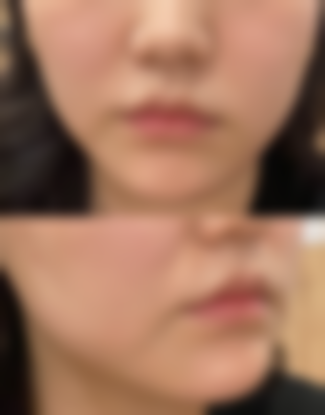 全切双眼皮术后出现低头呕吐导致眼皮发红，该如何处理？