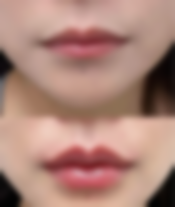 韩国TS整形能开展双眼皮宽改窄手术吗？