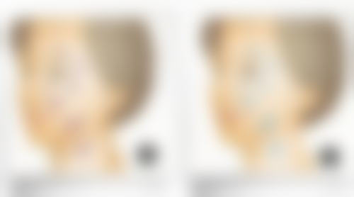 术后远期（3 - 6个月及以后）能完全修复正常吗？