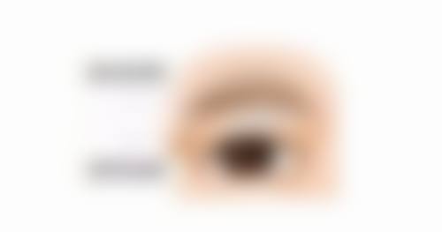 问：去做祛眼袋治疗，选择医院有什么建议吗？