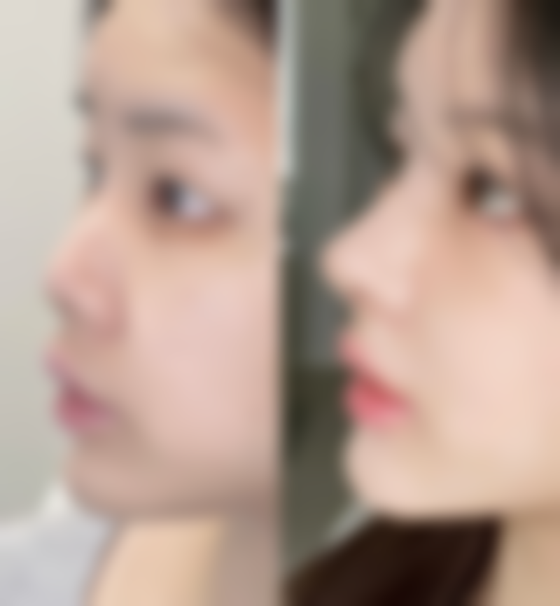 瘦脸针都是一样的吗？不同品牌效果有啥差异，安全性和维持时间又如何？ 