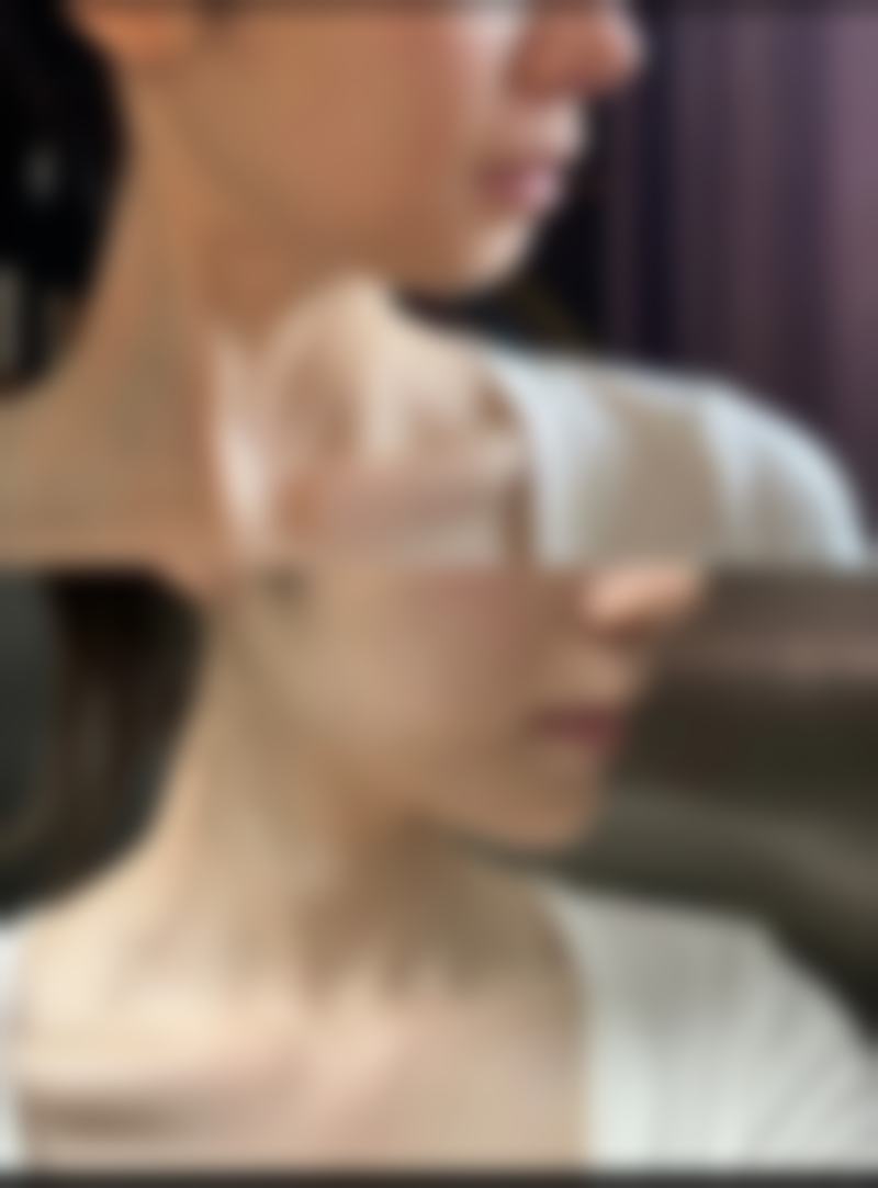 保妥适（Botox）有什么特点？