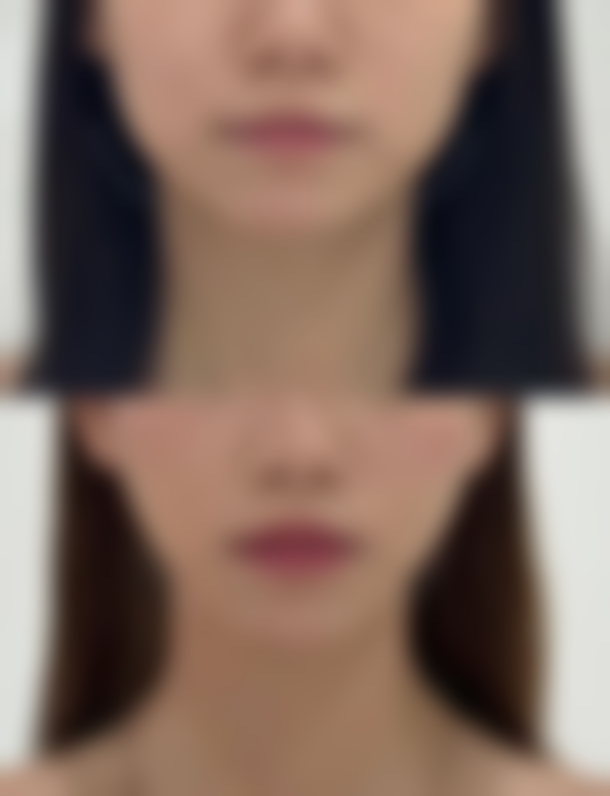 问：在选择祛眼袋方法时应该考虑哪些因素呢？