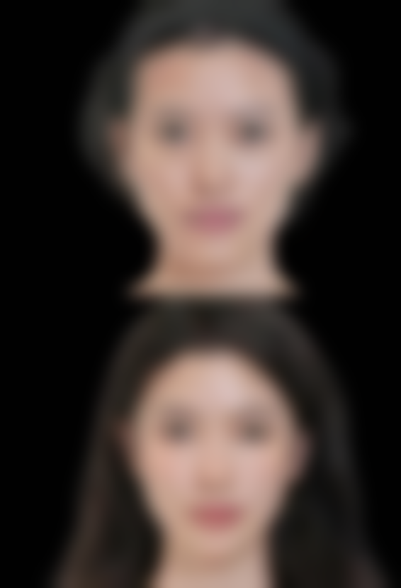 问：手术去眼袋有什么需要注意的吗？