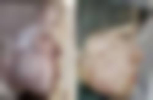 祛完眼袋不同阶段肿胀有什么特点，该怎么修复呢？