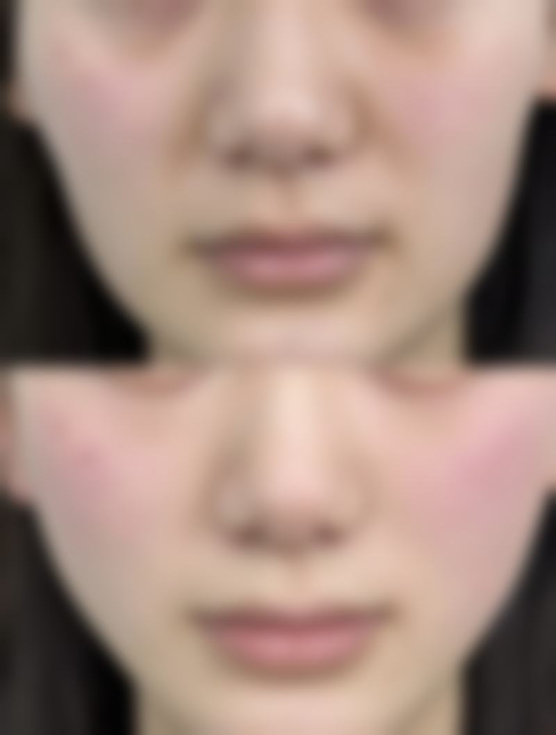 哪些因素会影响吸脂后反弹呢？