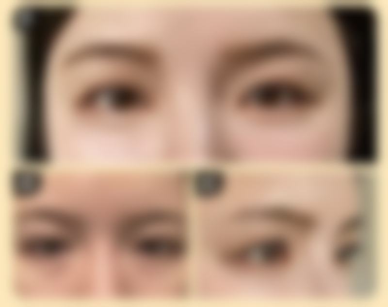 儿童疤痕能完全淡化吗？