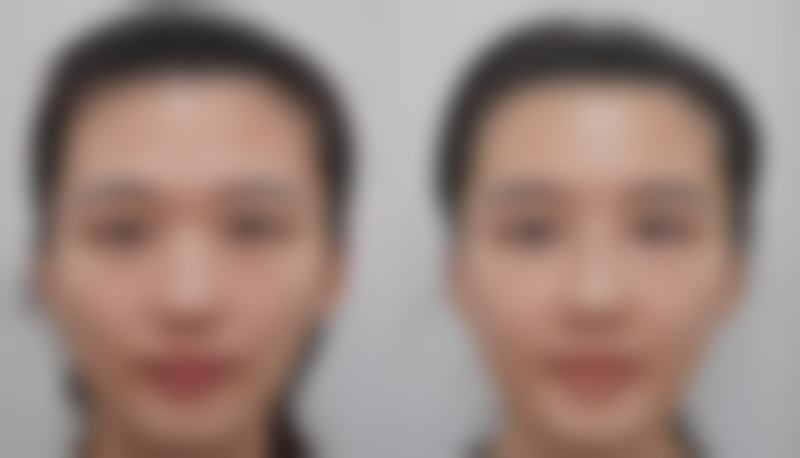 祛完眼袋后出现哪些异常情况需要复诊？