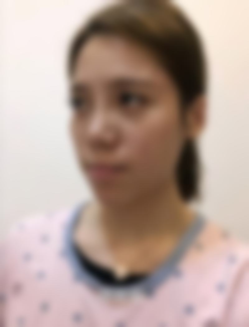 广东韩妃医疗美容医院鼻综合整形实例分享：术后修复过程是怎样的呢？