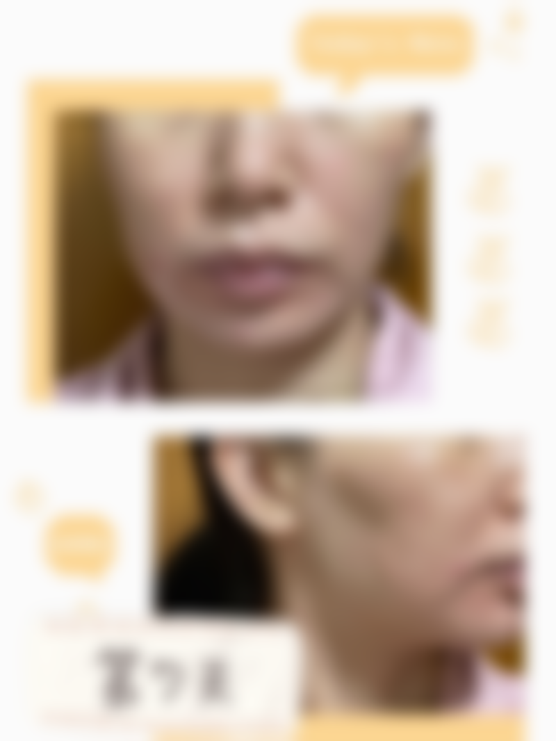 广东韩妃医疗美容医院蒋水清主事超声炮抗衰，整体感受咋样呢？