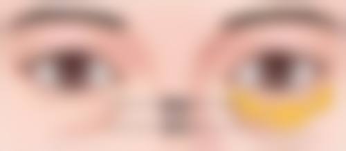 什么情况下需要手术修复疤痕印子？