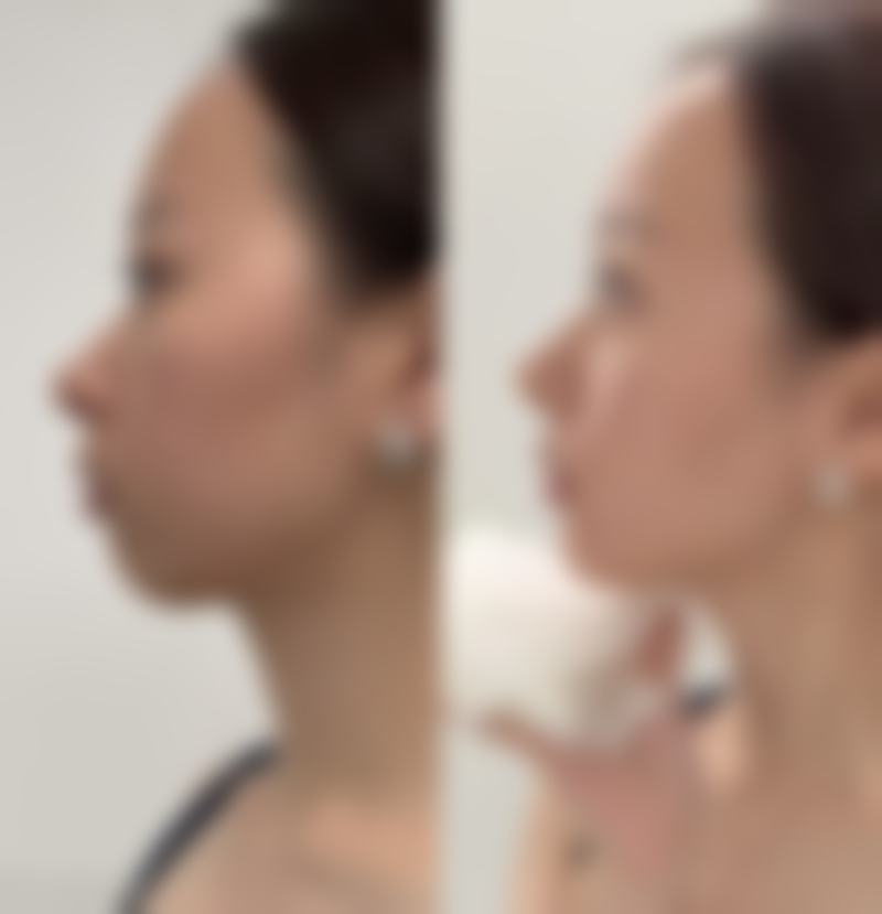 骨折手术疤痕增生治疗周期和注意事项有哪些？