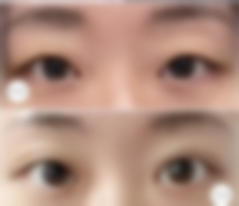 内吸眼袋去了还会长吗：眼袋抽脂肪后理论和实际情况一样吗？