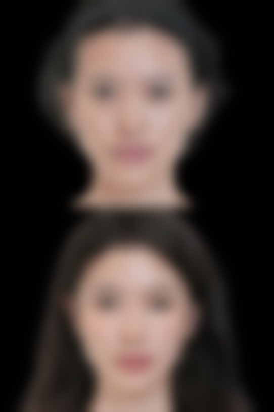 激光治疗疤痕印子是怎么回事？