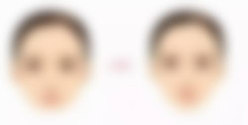 凸起疤痕用祛疤膏可以消除吗？答案是轻微凸起或可淡化，严重凸起难完全消除 